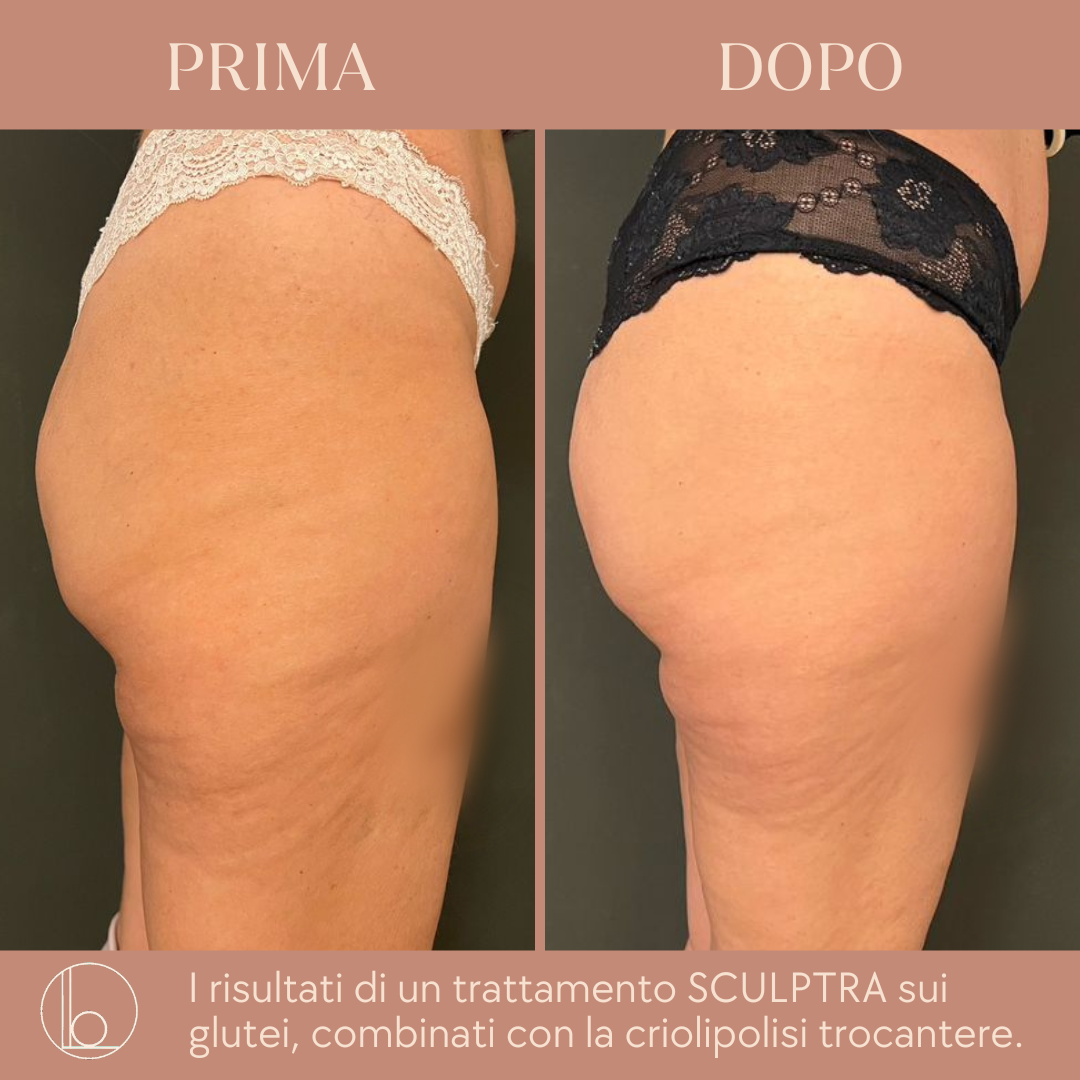 Sculptra 4