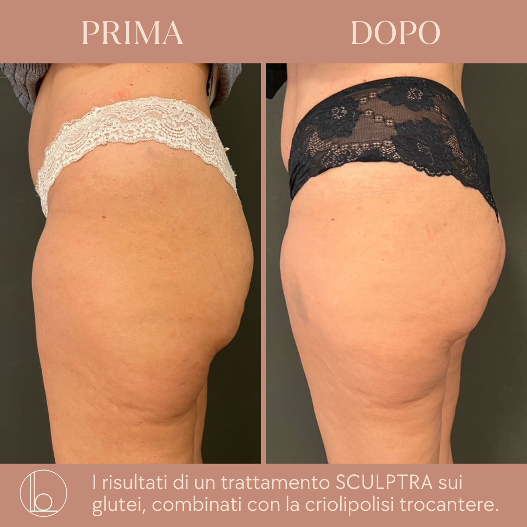 Sculptra 5